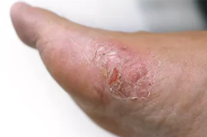 Jamur Lendir Selamatkan 2 Diabetes? Ini Kata Ahli Master